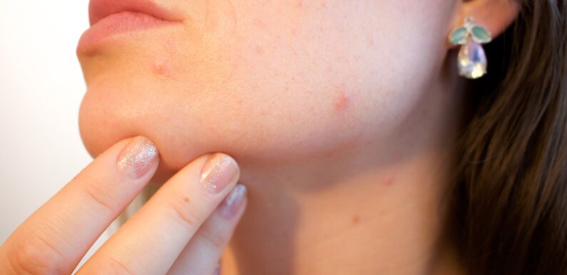 Acne Can Be A Pain To Live With